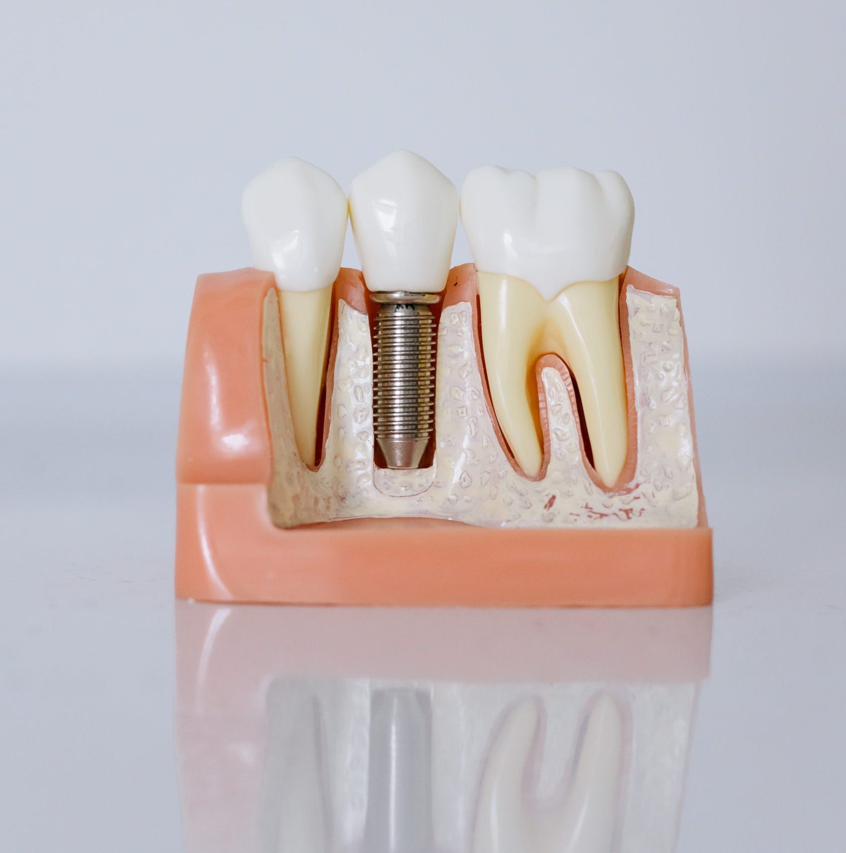 dental implants in huddersfield
