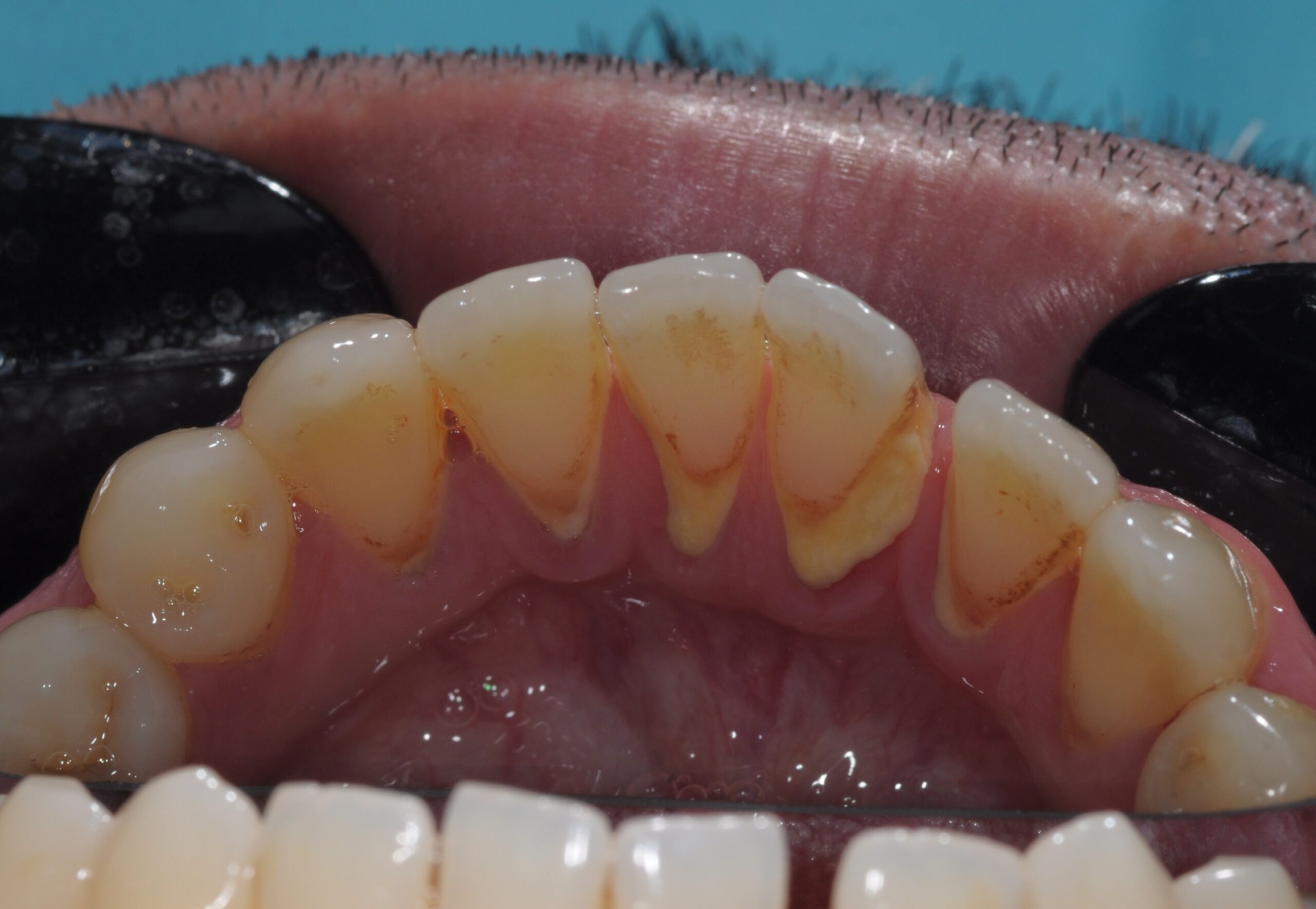 1.before_