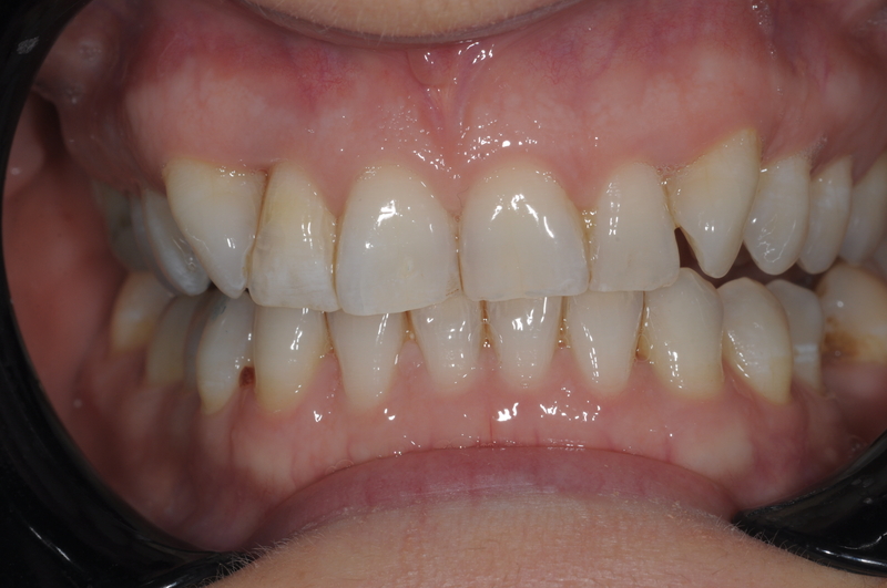 2.after