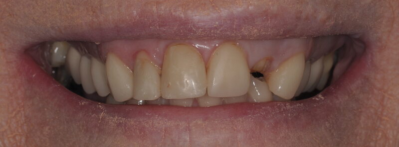 2a before