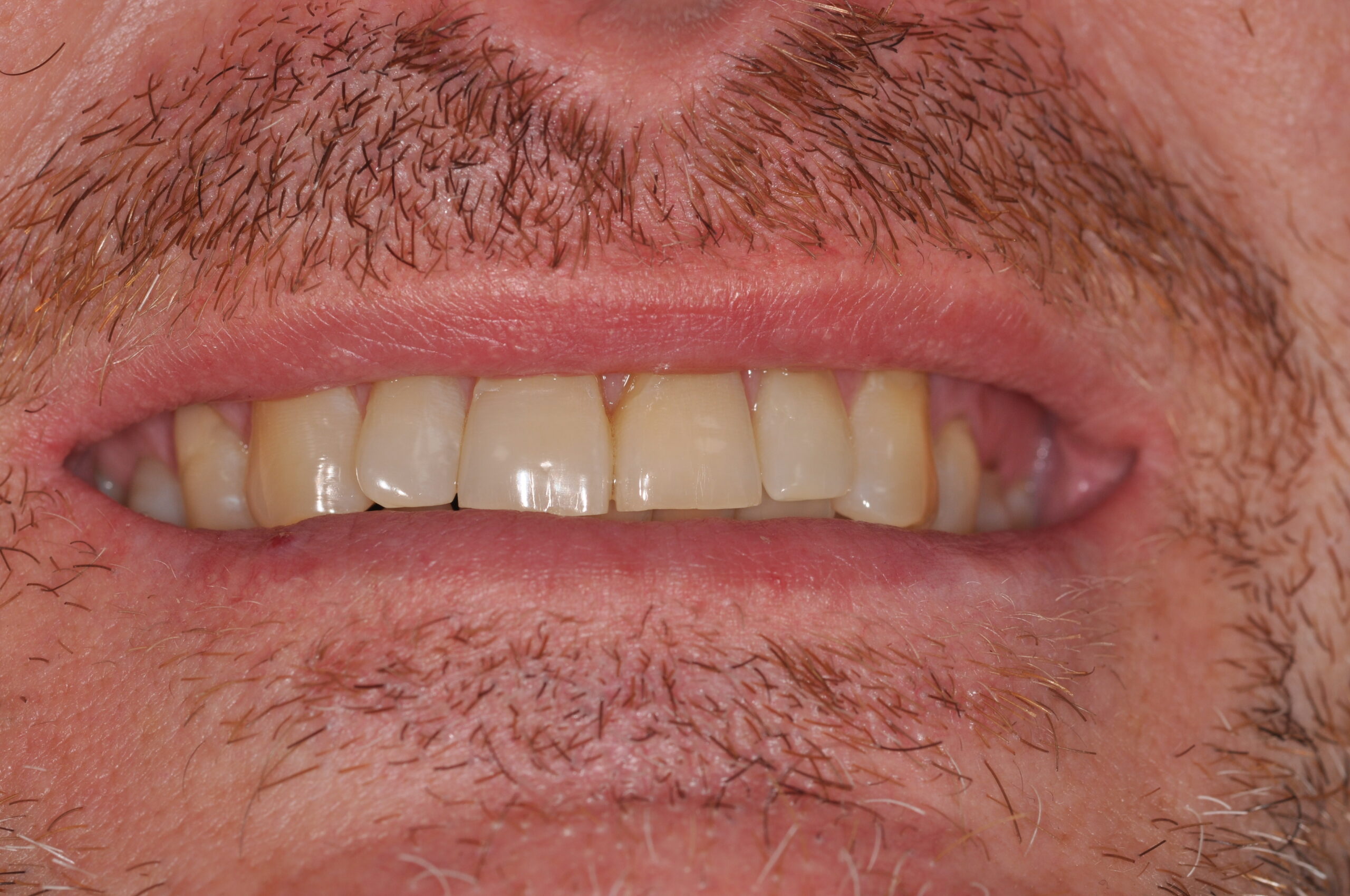 3. before