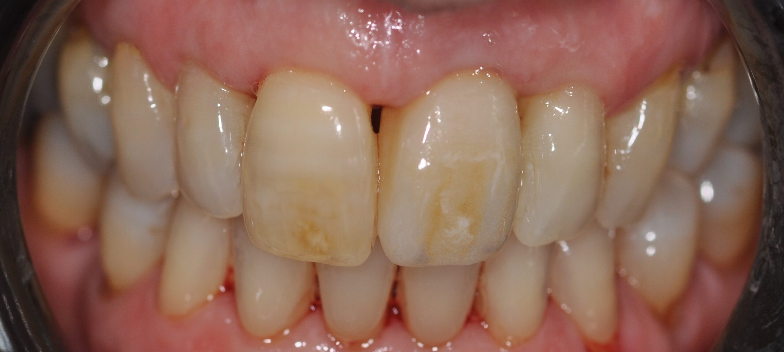 4after (2)