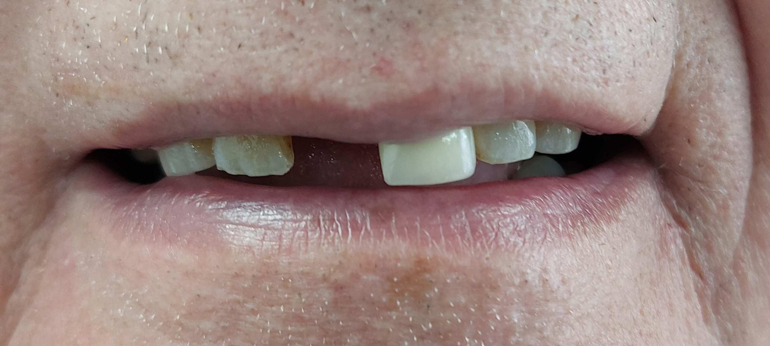 5before