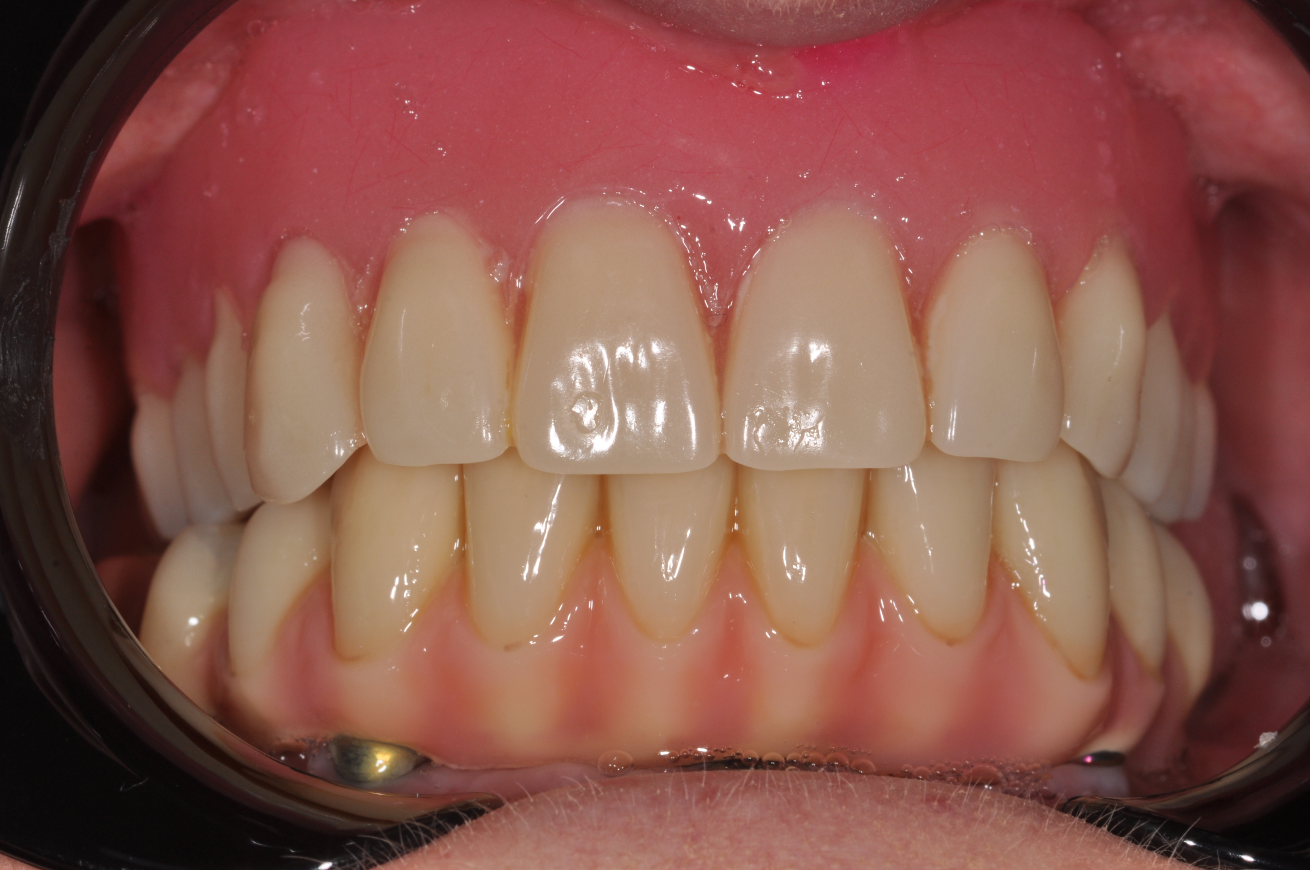 after-implant