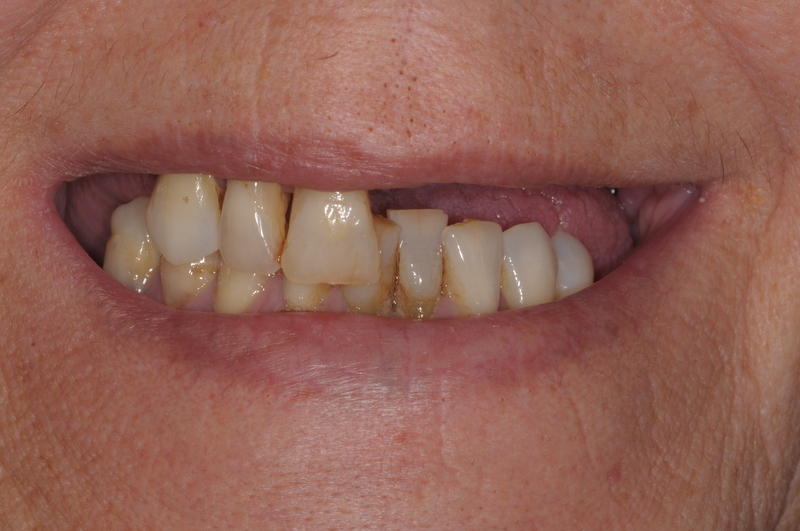 before digital dentures