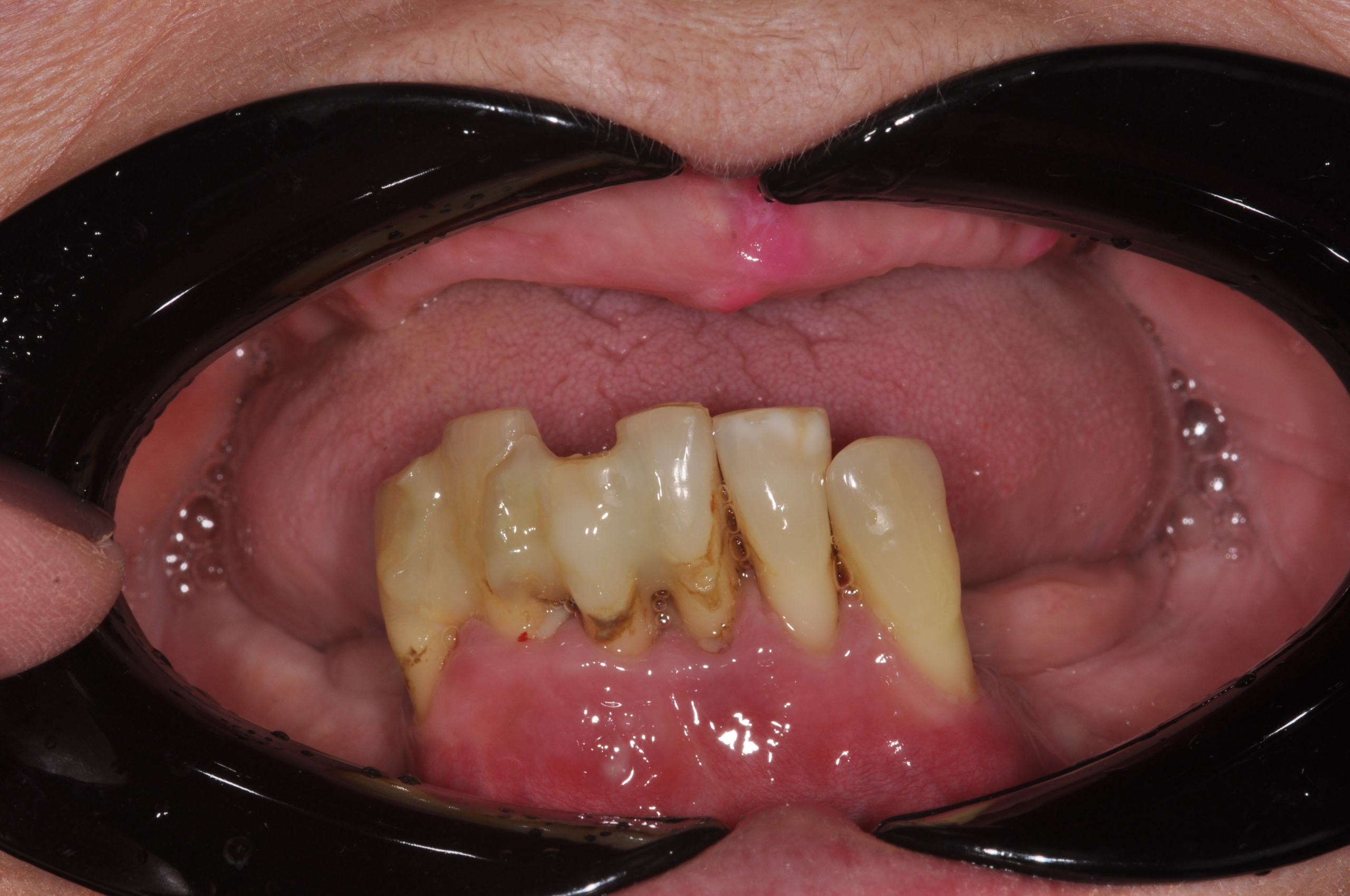before-implant