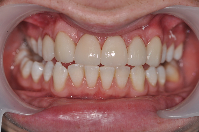 veneers.after1