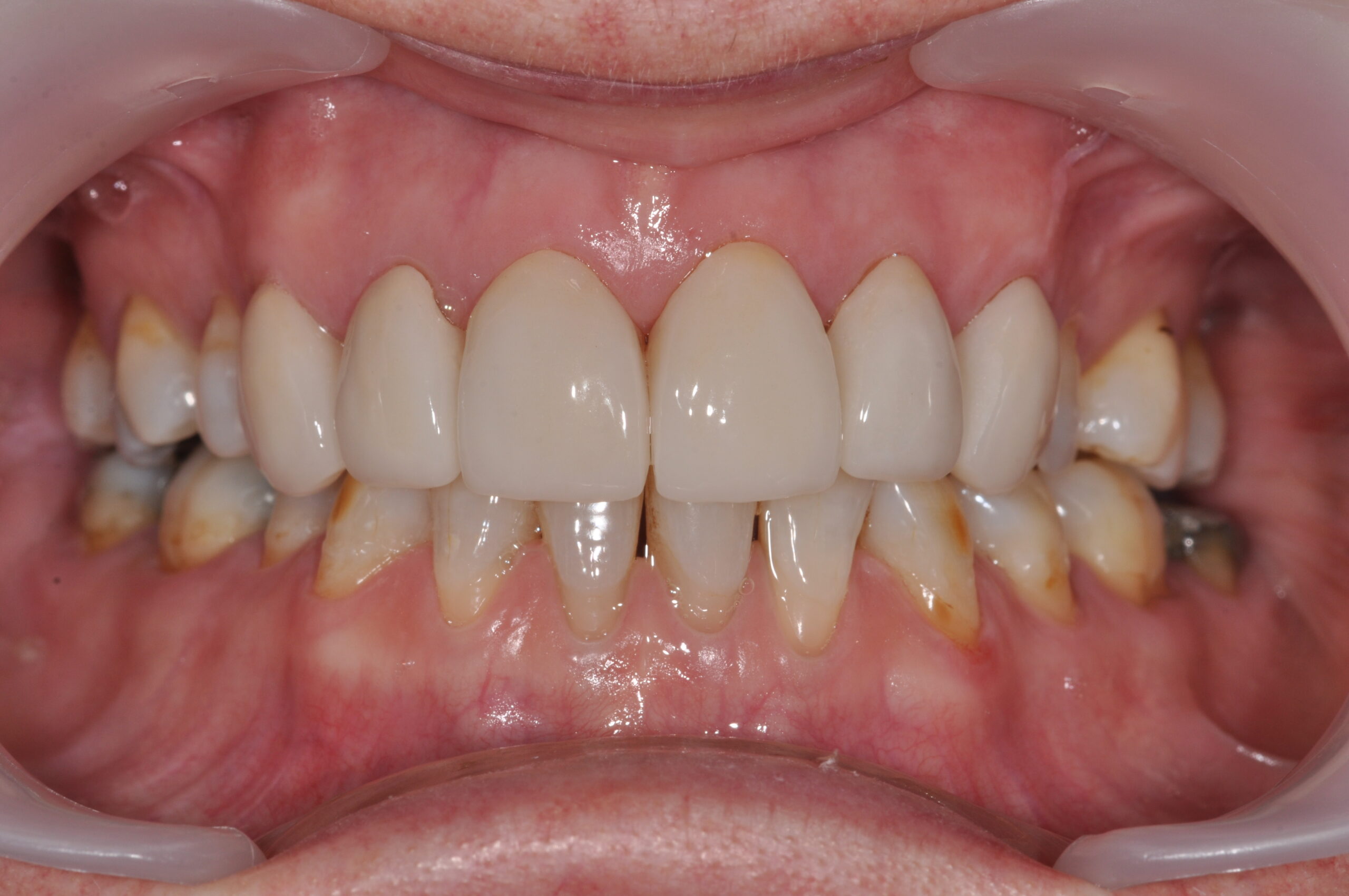 veneers.after2