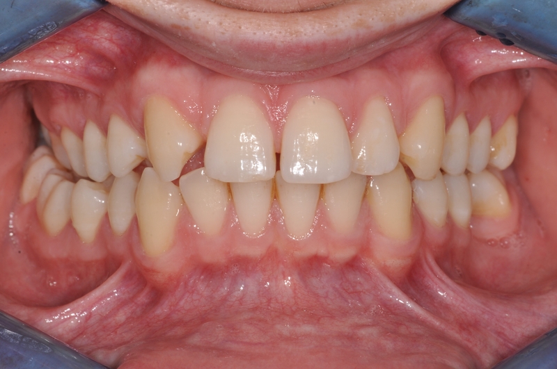 veneers.before1 veneers.before1