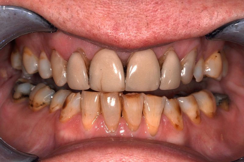 veneers.before2 veneers.before2