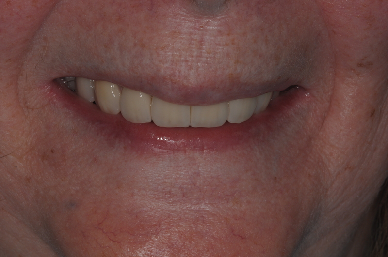 2.after
